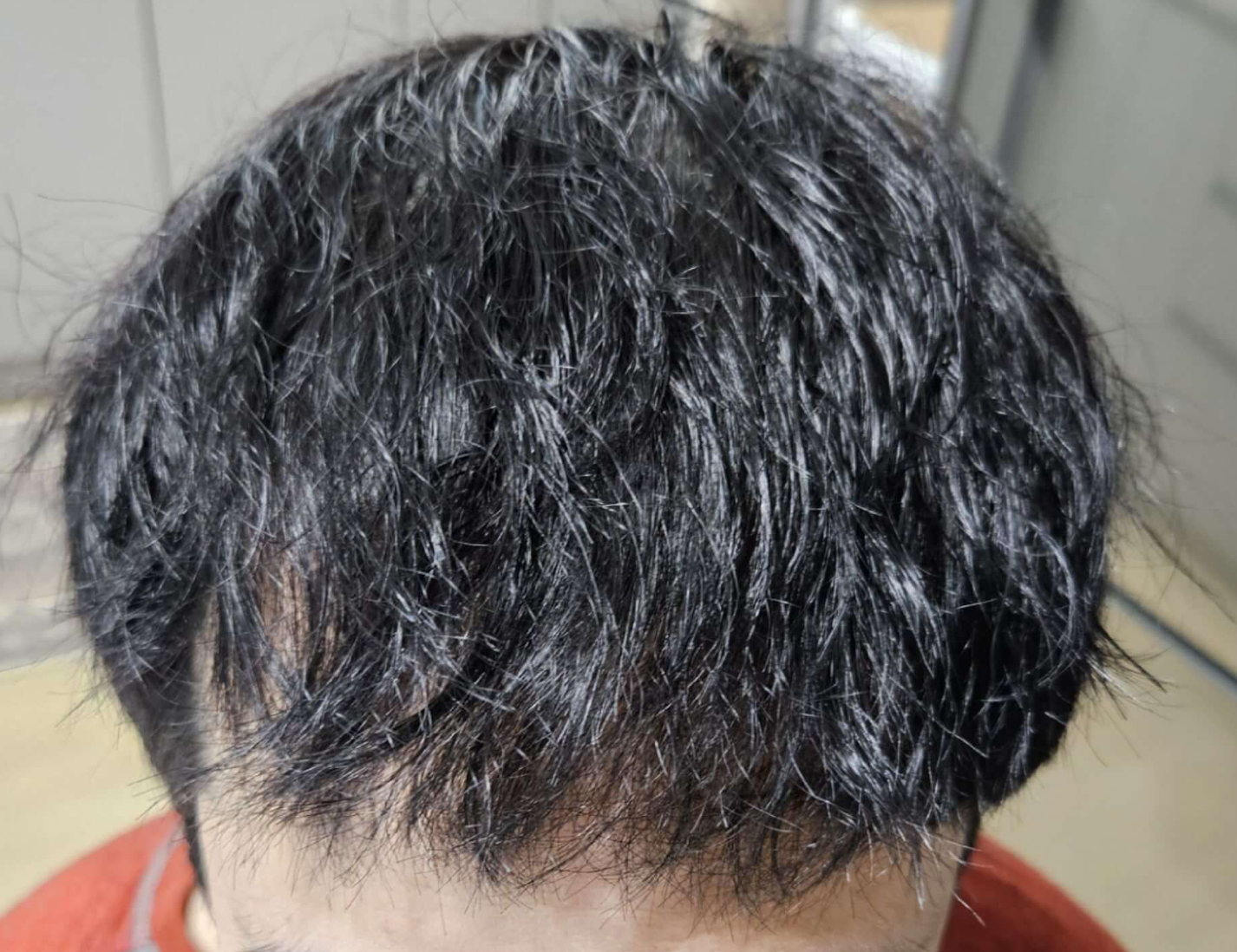 남자 M자탈모 붙임머리