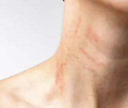 몸이 가려운 이유 11