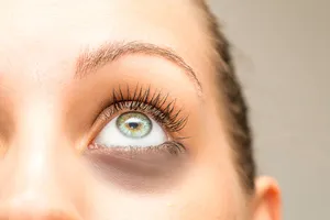 레이저-눈밑-지방재배치