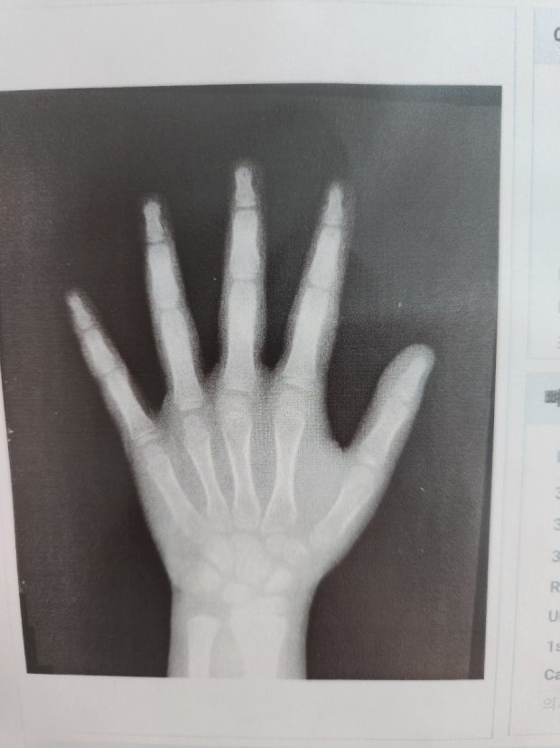 성장판 검사 관련 사진