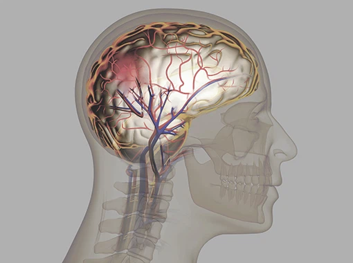 뇌졸중 전조증상