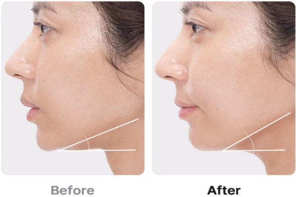 메디큐브 부스터프로 내돈내산 후기