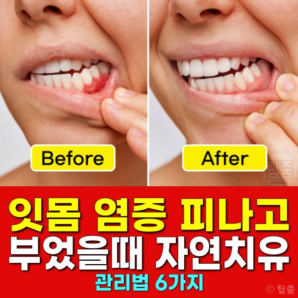 잇몸 염증 피나고 부었을때 좋은 자연치유 관리법 치은염 치료