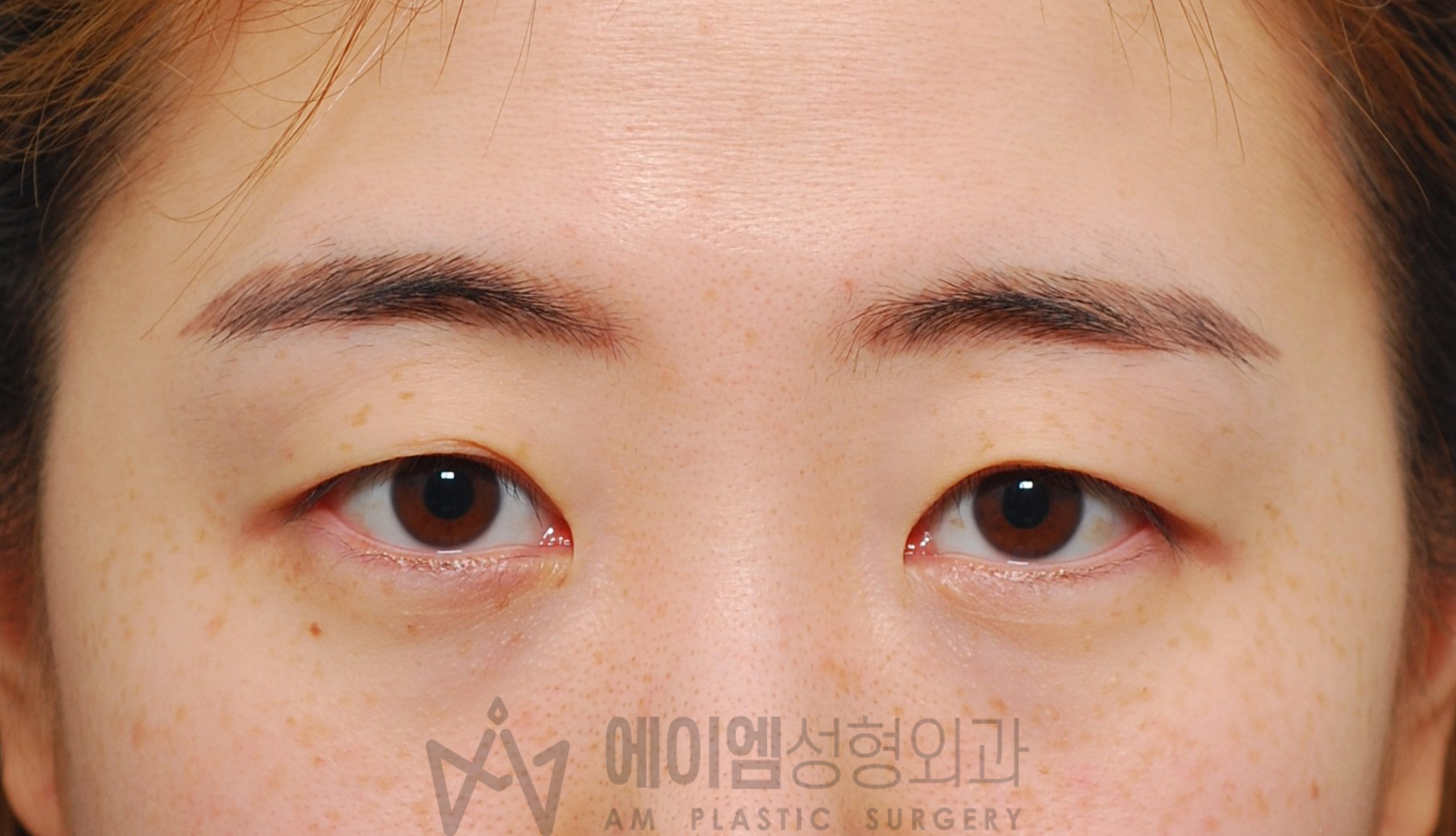 쌍꺼풀 풀림 수술 전