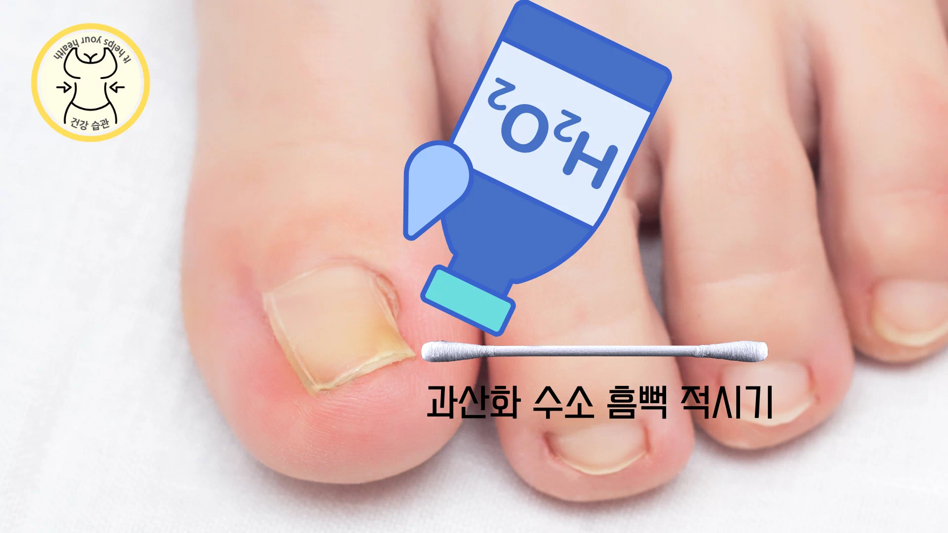 내성 발톱 치료 방법 - 면봉 끼우기