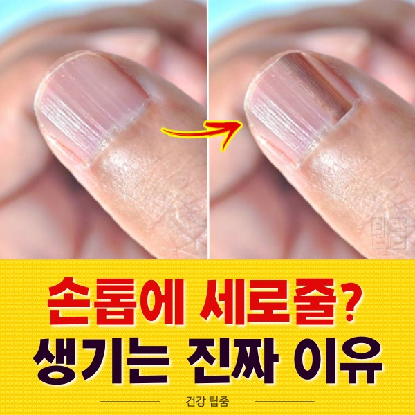 손톱에 세로줄이 생기는 이유, 손톱 검은 세로줄 흑새종, 손톱으로 보는 건강상태, 건강 팁줌 매일꿀정보