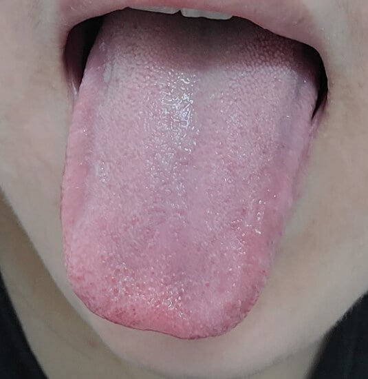 설태제거해야하는이유