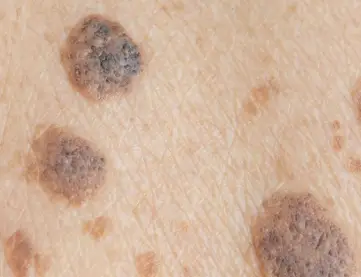 검버섯-발생-이미지