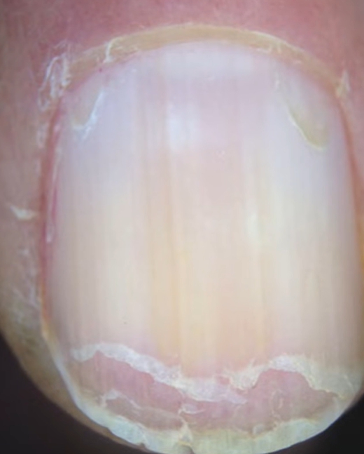 손톱이 잘 부러지는 이유