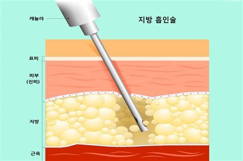 지방흡입술가격
