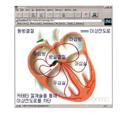 부정맥 치료법 및 증상 예방법 총정리