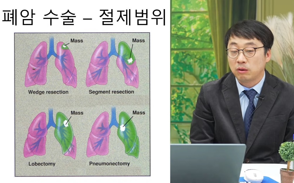 폐암-명의-이창영-교수