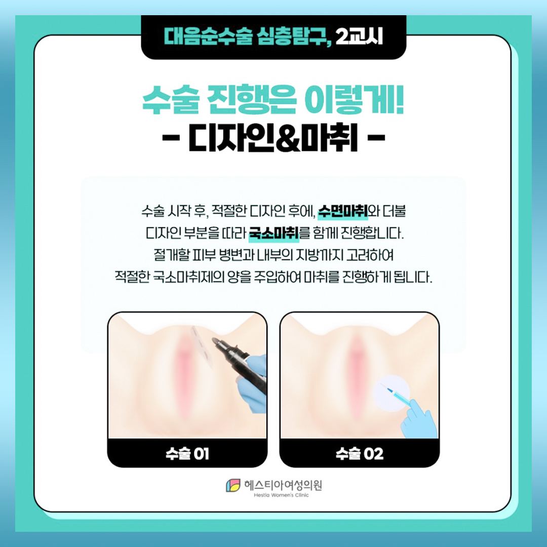 대음순성형수술 수술 진행 
디자인마취