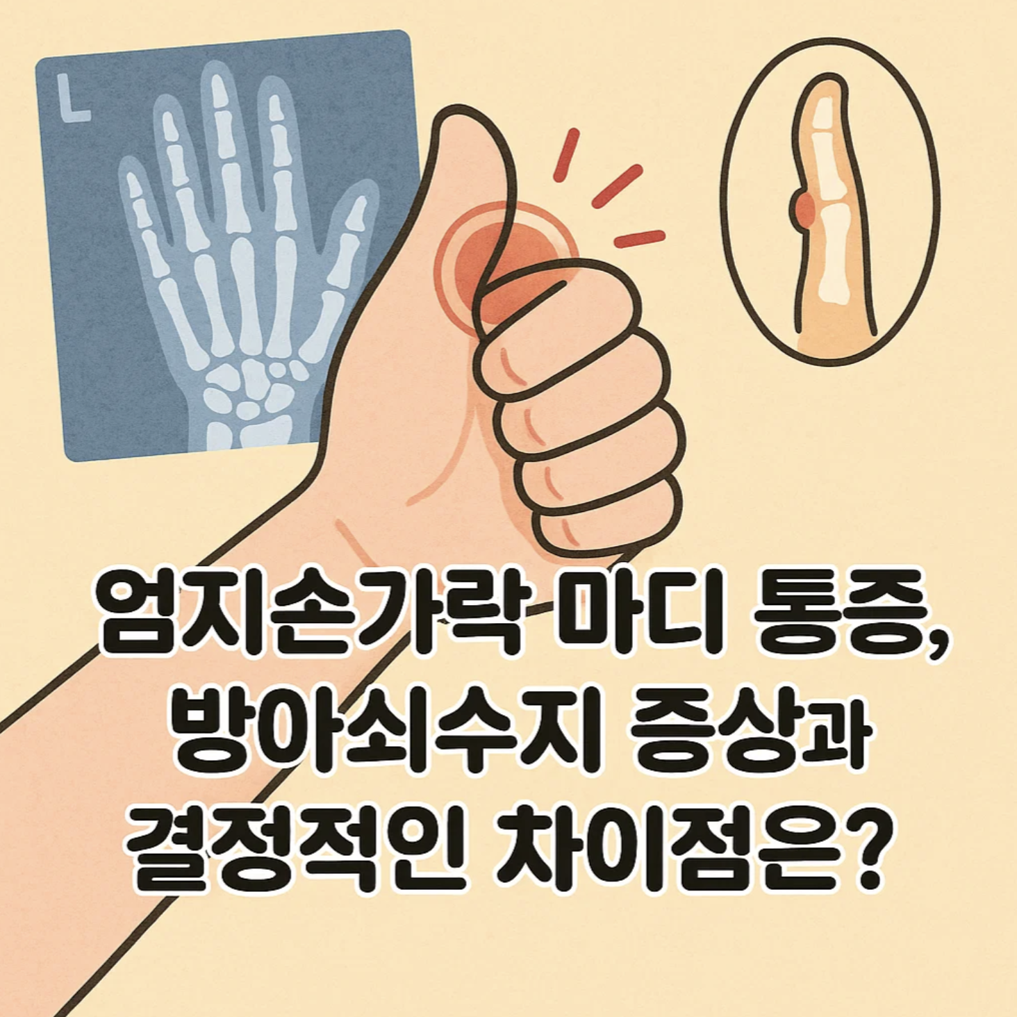 엄지손가락 마디 통증, 방아쇠수지 증상과 결정적인 차이점은?