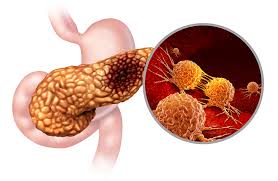 췌장암이 치료하기 힘든 이유: 생존율을 낮추는 여러 요인들