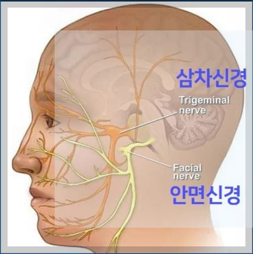 삼차 신경통
