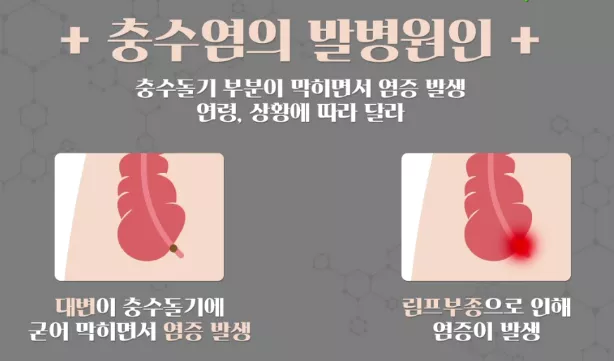 충수염-원인