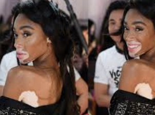 백반증 초기증상 11