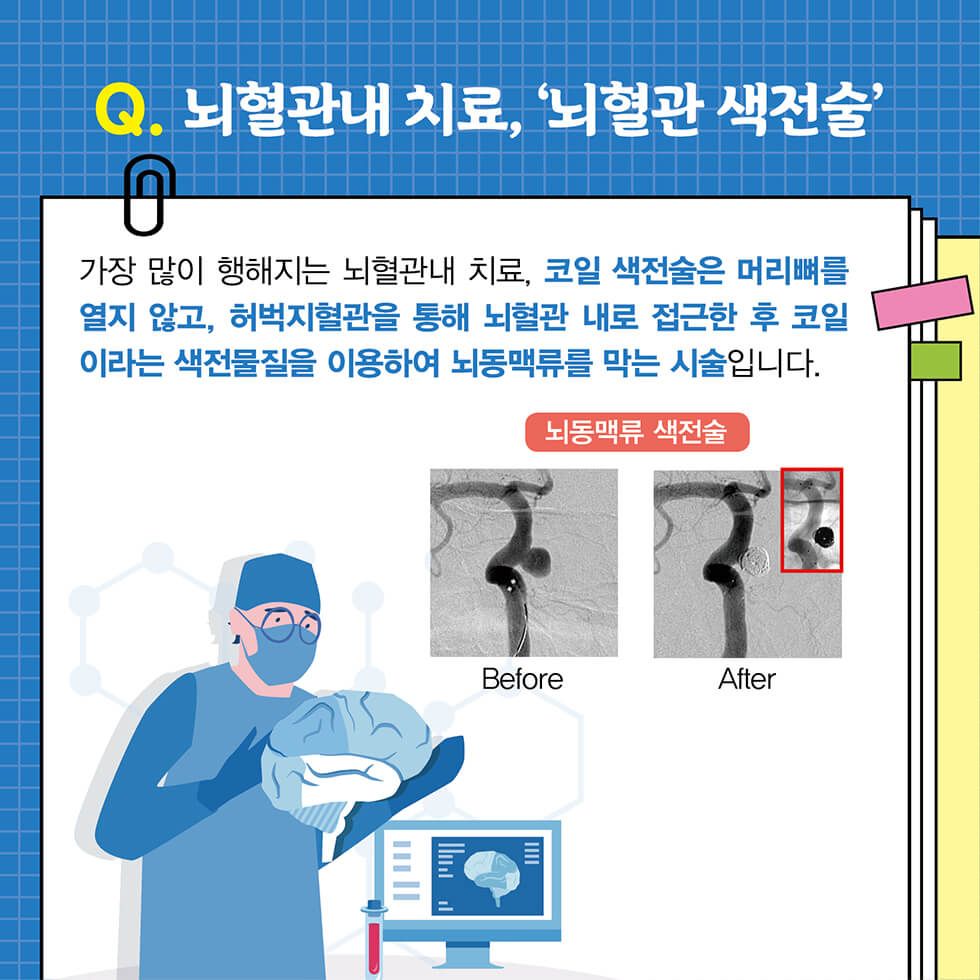 뇌동맥류 총정리 원인 증상 치료법 예방