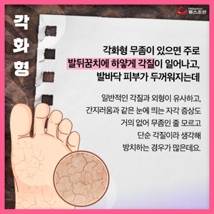발바닥갈라짐