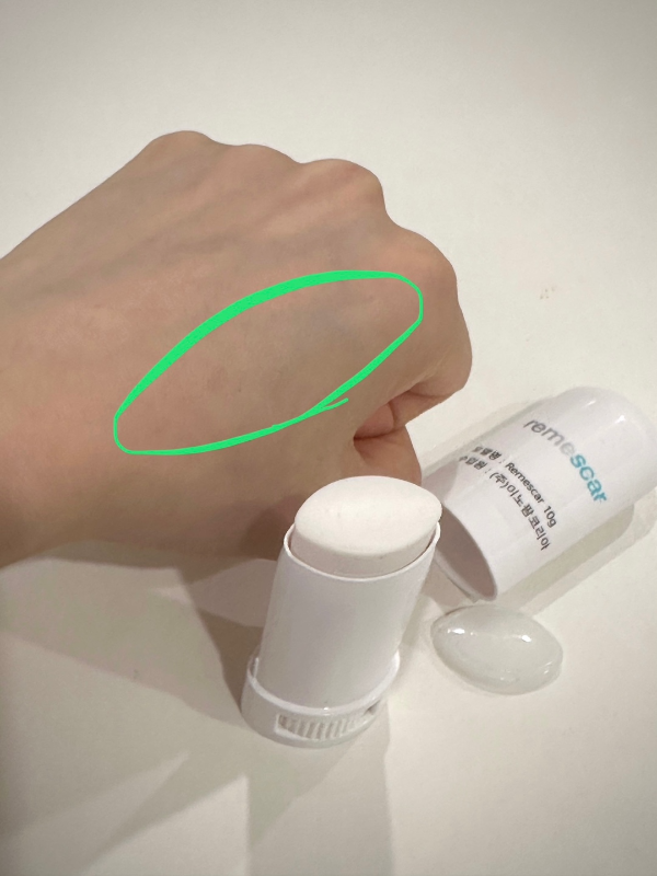 갑상선 암, 림프절 암 수술 흉터 관리 - 리메스카