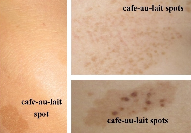 밀크커피색반점