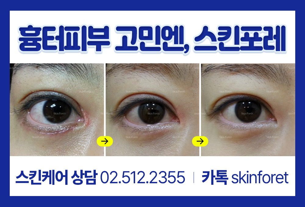 앞트임 복원 후 눈앞머리 흉살 케어 과정
