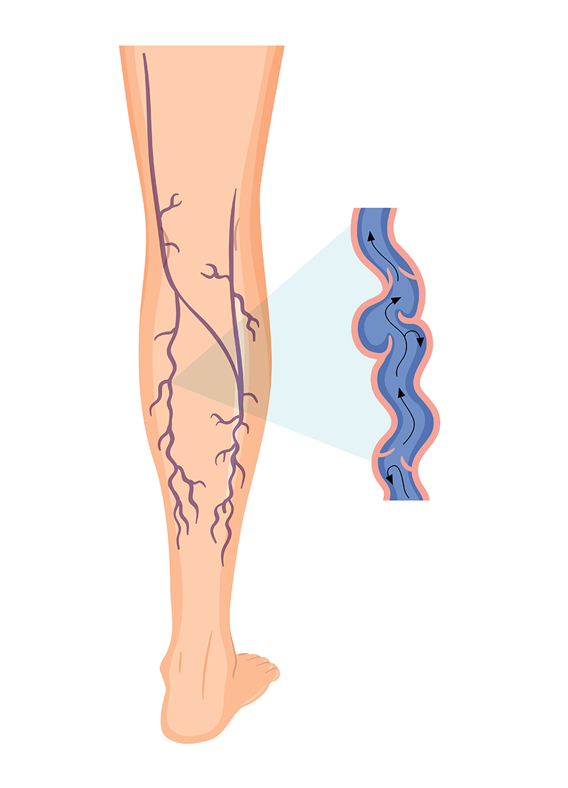 하지정맥이 생긴 다리를 표현한 그림, 보라색 혈관이 울퉁불퉁하게 보인다.