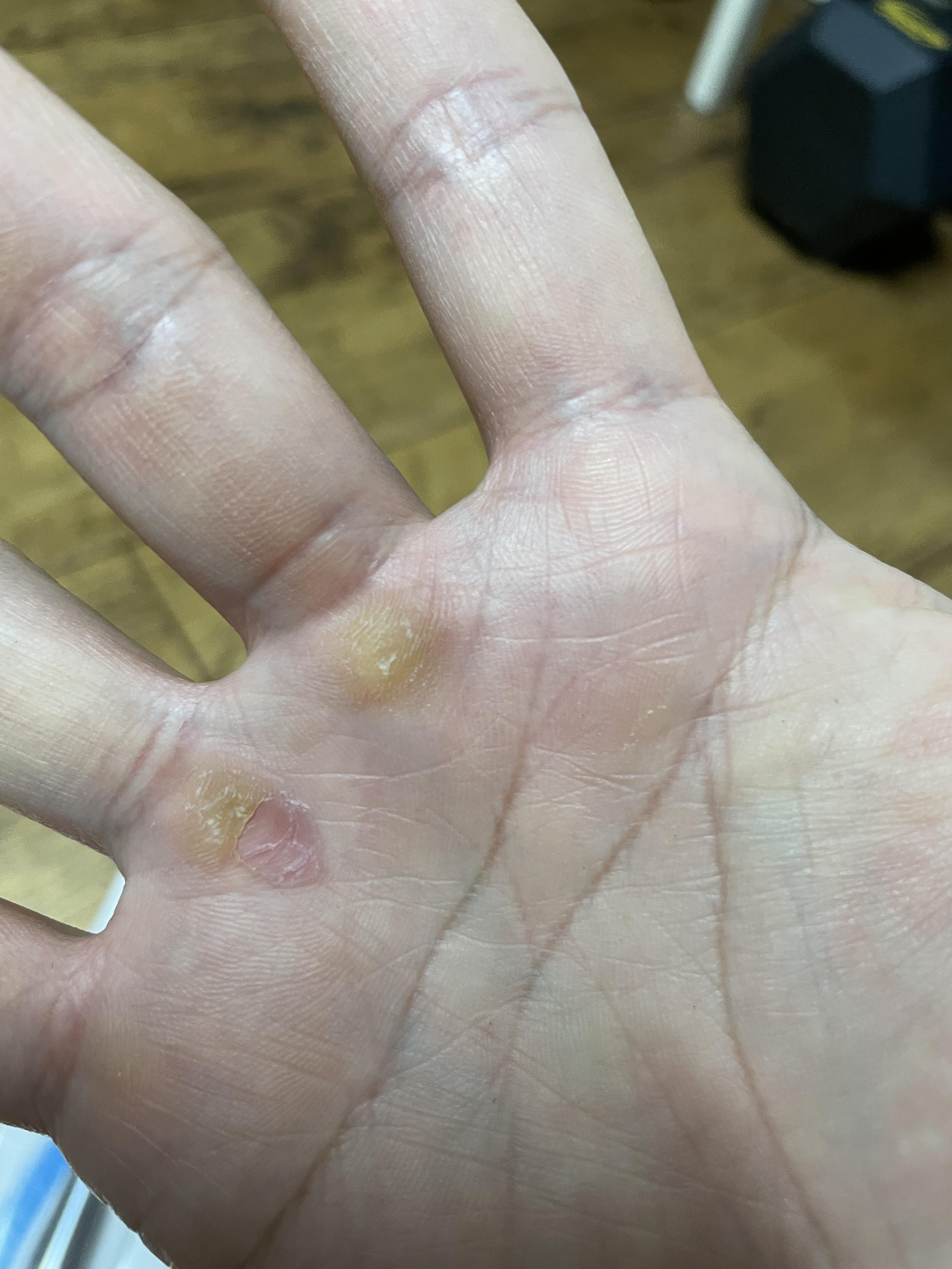 손바닥 굳은살 제거기