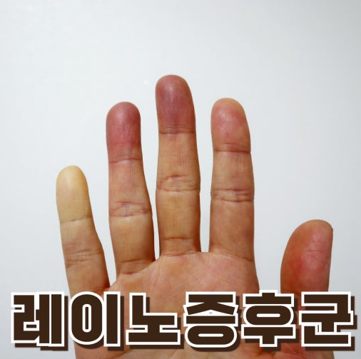 레이노 증후군 증상 손끝이 하얗게 변한다면