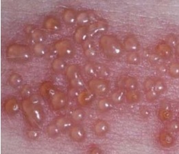 헤르페스 2형 바이러스 증상 