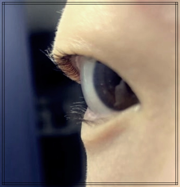 안검 내반 수술: 장점과 단점