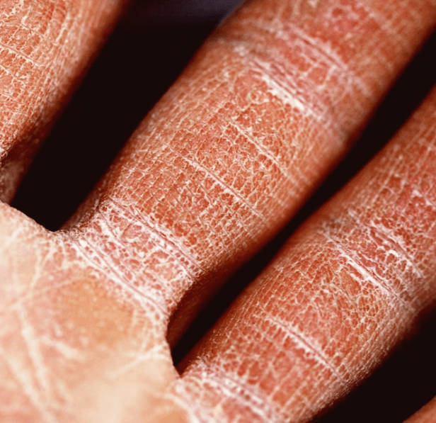 모공각화증 치료방법 - 박피 치료