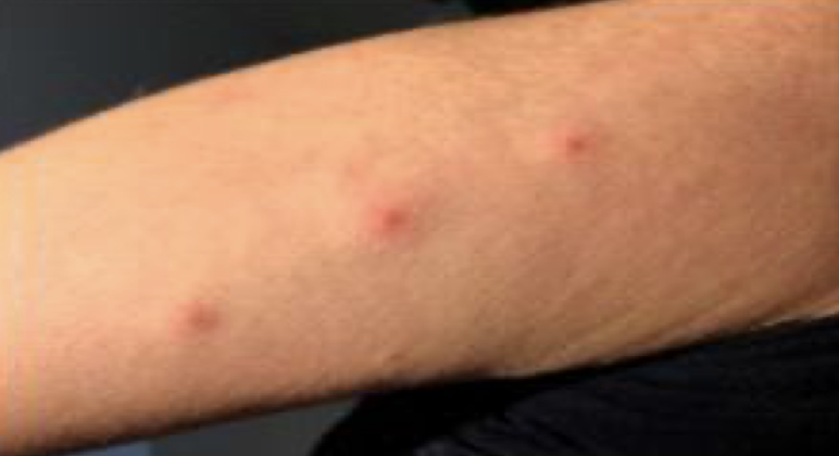 빈대 물린자국
