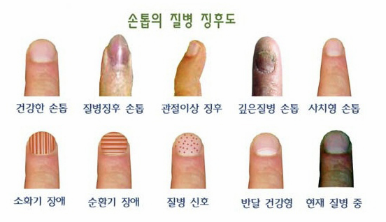 손톱의 질병 징후도 이미지
