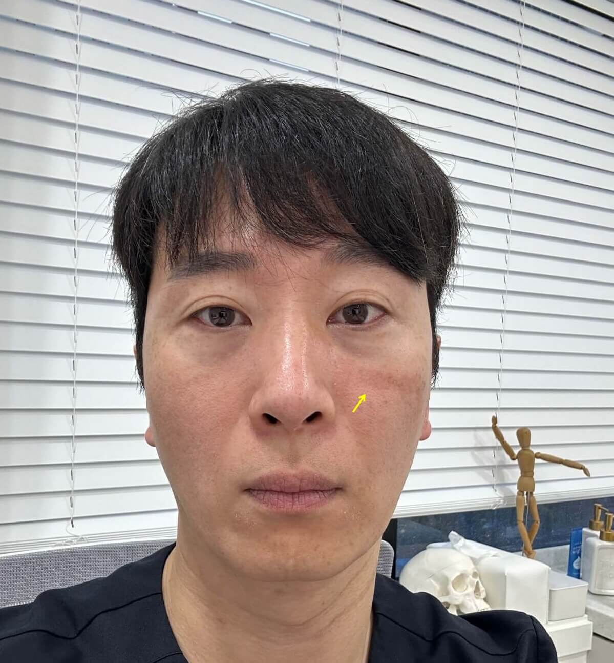 과색소침착