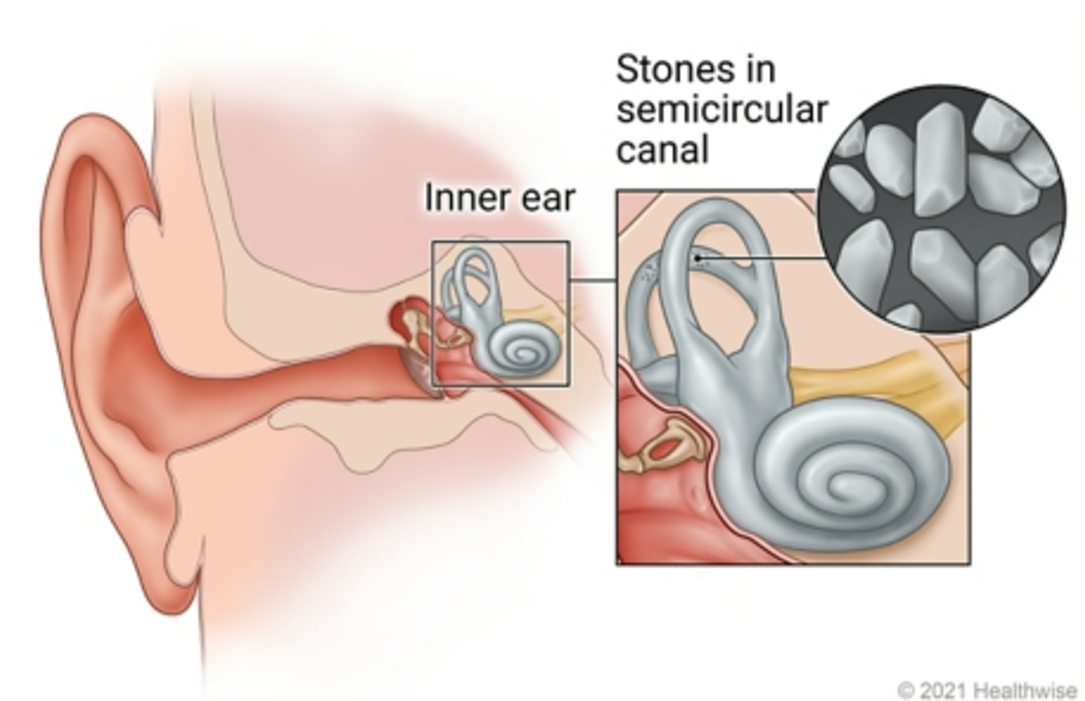 귀 속에 있는 이석기관을 표현한 사진이다.