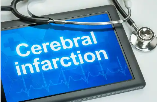 뇌경색 초기증상, 원인 및 치료 방법