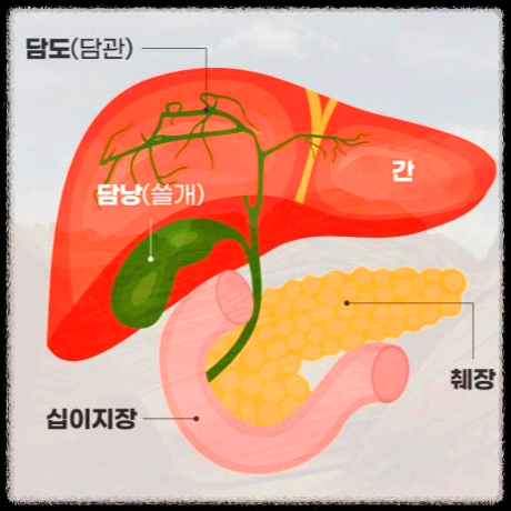 담석증의 증상, 치료 방법과 수술의 종류
