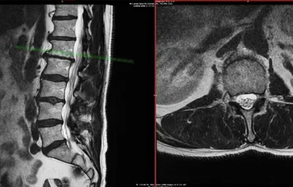 허리디스크 내장증 통증: 원인과 해결방법.