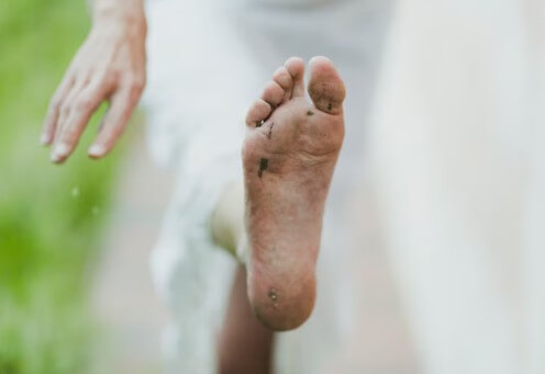 무좀-증상과-효과적인-치료법-1