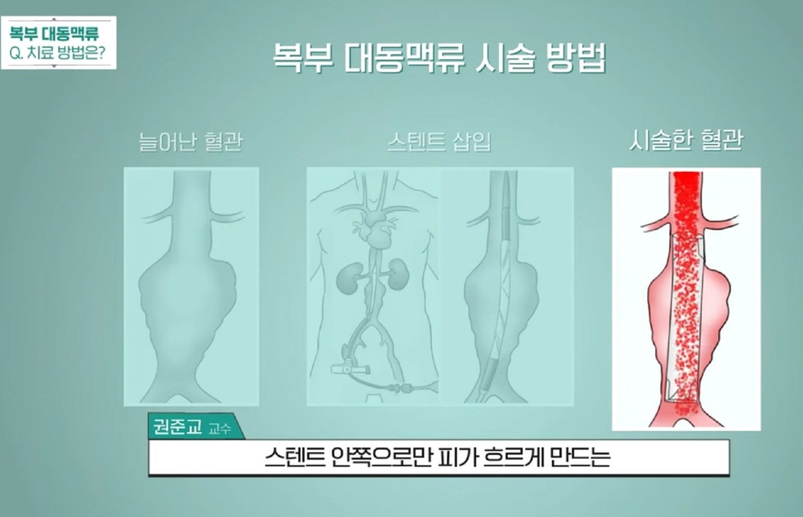 복부대동맥-시술-방법