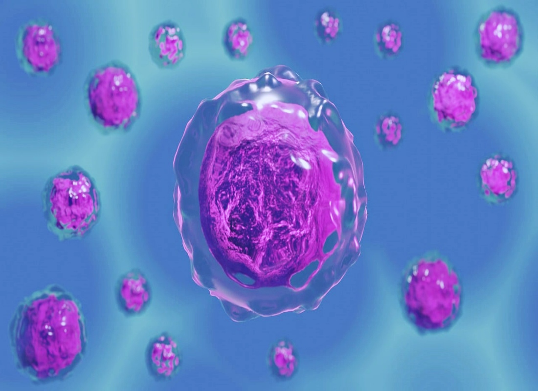 자궁경부비정형세포 사진