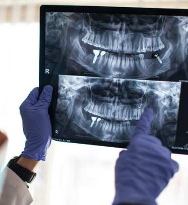 임플란트 가격 비교 사이트별 비용 총정리