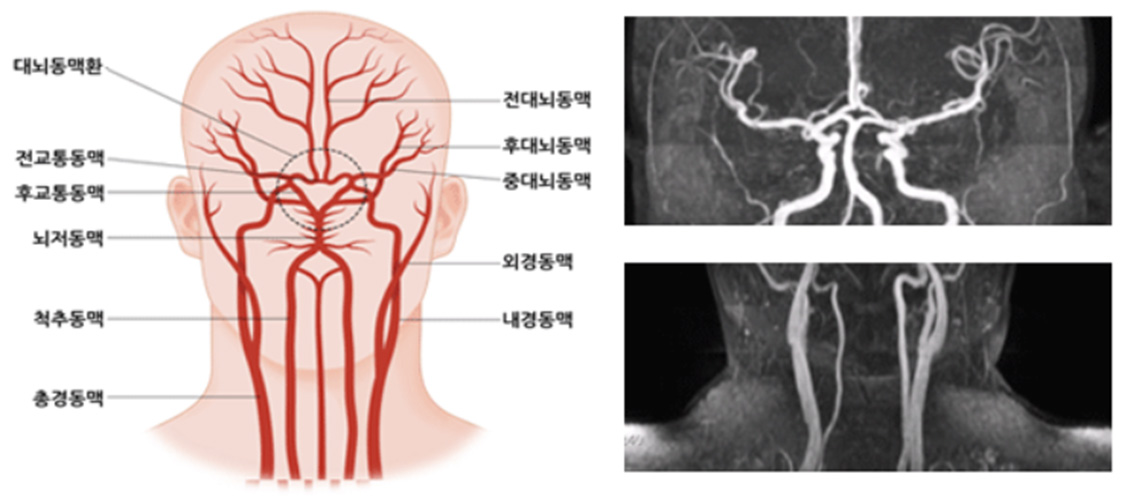 뇌혈관질환 관련사진