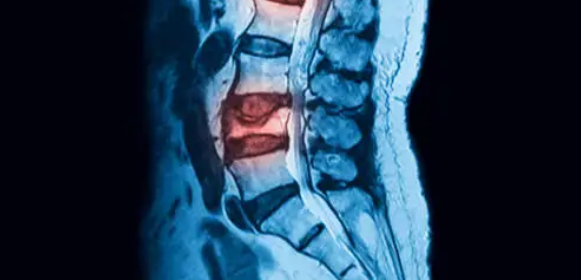 퇴행성 척추질환과 관련된 사진