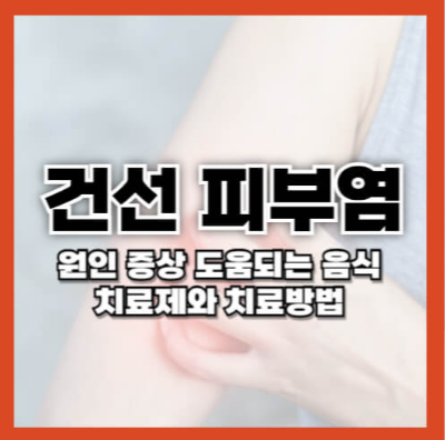 건선 초기증상, 건선 치료제, 건선 관리법, 건선 치료법, 건선 원인, 건선 보습제