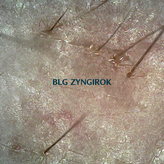 피나모아 복용 22주차 - 오른쪽 M자 부위 두피 모습이다.