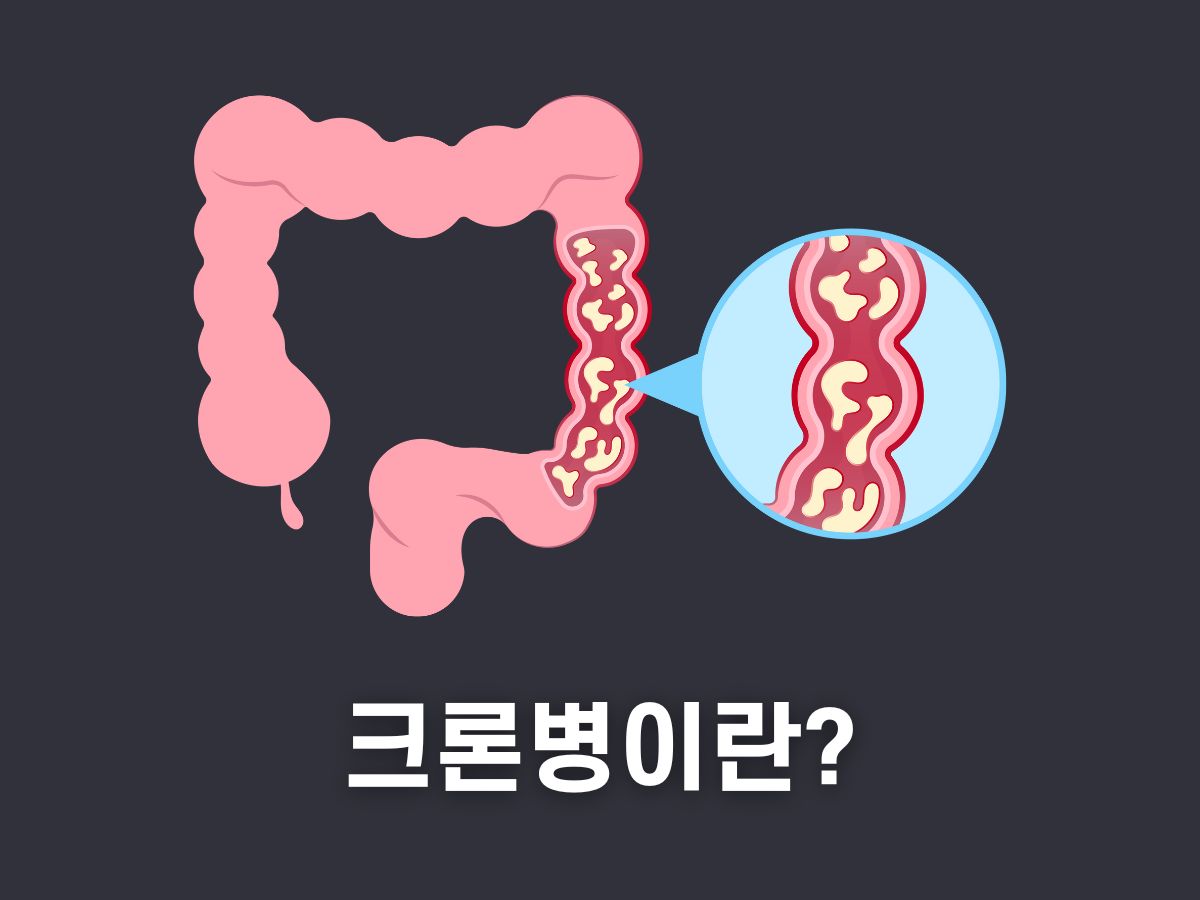 크론병이란
