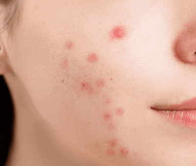 여드름 치료에 좋은 연고 디페린겔 사용법 직구 방법 가격 효과 부작용